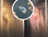 تفاصيل زراعة أول أذن من خلايا بشرية (فيديو)