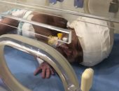 إجراء جراحة عاجلة بالمخ لطفلة من نزلاء مركز الإيواء بالعاشر من رمضان