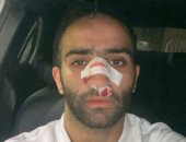 عموري يجرى أشعة مقطعية بعد تعرضه لنزيف بالأنف في مباراة المصري والجونة