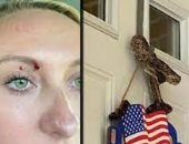  أمريكية تُفاجأ بثعبان على باب منزلها يلدغها بالقرب من عينيها.. صور
