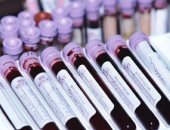 دراسة: كثافة الدم تزيد خطر الإصابة بمضاعفات كورونا