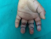 إنقاذ يد طفلة من البتر فى جراحة ناجحة بأحد المستشفيات فى الغربية