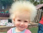 متلازمة شعر "المقشة" تصيب طفلة بريطانية ضمن 100 شخص بالعالم