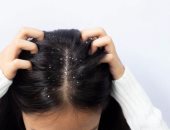 وصفات طبيعية لعلاج قشرة الشعر.. المكونات متوفرة فى بيتك