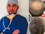 جراح بريطانى يكشف علاقة كورونا بزيادة حالات تساقط الشعر ويلجأ لتقنيات علاج حديثة
