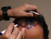 4300 دولار وموت مبكر.. عملية "زراعة شعر" تنتهى بمأساة فى الهند (فيديو)