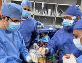 فريق جراحى ببنها الجامعي ينجح في تغيير الصمام الميترالى بالقلب دون شق صدرى