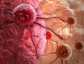 نصائح غذائية لإدارة الآثار الجانبية لعلاج السرطان