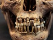 دراسة: إجراء تقويم أسنان فى القرن الـ17 لحماية ابتسامة النخبة فى فرنسا