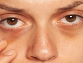 4 علاجات منزلية فعالة للتخلص من النتوءات البيضاء تحت العيون