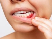 ديلى ميل: تنظيف الأسنان بشكل صحيح يقلل من الإصابة بالتهاب المفاصل