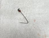 فريق جراحى بمستشفى بنها الجامعى يستخرج "دبوس" من القصبة الهوائية لفتاة 18 عاما