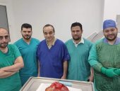 استئصال ورم يزن 7 كيلو من بطن مريضة بمستشفى الباجور فى المنوفية