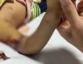 فريق طبى بمستشفى سوهاج الجامعى ينجح فى استعادة زراع طفله مبتور