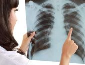 التدخين والتلوث من أكثر الأسباب شيوعًا لسرطان الرئة.. فيديو