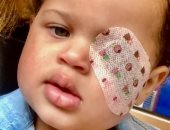 طفلة أمريكية تفقد عينها اليسرى بعد تشخيصها بالخطأ بمرض الأكزيما  