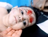 إسرائيل تستهدف غزة بالفسفور الأبيض.. استشهاد 326 طفلا وإصابة 1217 آخرين
