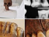 دراسة حديثة: الفايكنج اعتنوا بالأسنان بطرق مثيرة للدهشة