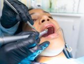 سيدة أمريكية تقاضى طبيب أسنان أجرى لها 32 عملية فى جلسة واحدة