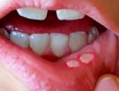 اعرفى أعراض فطريات الفم عند الأطفال وطرق الوقاية.. استشاري توضح