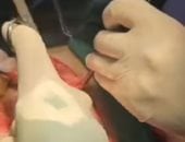 عملية جراحية لرجل يمنى بعد ابتلاعه 80 قلمًا و سماعتى أذن