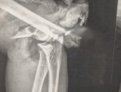 فريق طبي بمستشفى سوهاج الجامعى ينقذ ذراع سيدة من البتر.. اعرف التفاصيل
