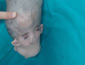 للمرة الأولى بجامعة الإسكندرية.. نجاح عملية نادرة لفصل توأم ملتصق من الرأس  