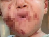 3 فرق طبية بمستشفى سوهاج الجامعى تعيد فتح فم طفل تعرض للدغات نحل.. صور