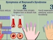 اختبار مدته دقيقة يكشف إذا كنت تعاني من مرض برودة الأطراف "رينود"