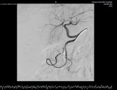فريق طبى بمستشفى سوهاج الجامعى ينقذ حياة مريض عمره 75 سنة بوقف نزف شرياني حاد
