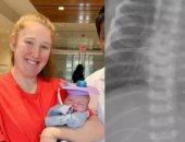 زرع أصغر جهاز تنظيم ضربات القلب في العالم لطفل عمره شهرين.. اعرف قصته