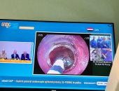 إنجاز طبى لجامعة حلوان: جراحة نادرة بمناظير الفراغ الثالث وبث مباشر لـ9 دول