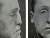 كيف أعادت الجراحة التجميلية الأمل لمصابى الحرب العالمية الأولى.. صور