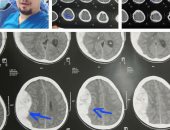 إنقاذ حياة طفل يعانى نزيفا بالمخ فى مستشفى كفر شكر التخصصى.. التفاصيل