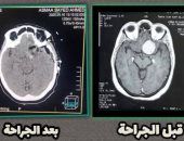 فريق طبى بمستشفى بلطيم يستأصل ورما بالمخ لمريضة ويعيد البصر لعينها اليسرى
