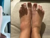 امرأة أصيبت بعدوى فطرية سببت لها فقدان ذاكرة ونوبات صرع.. كيف حدث ذلك؟