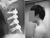 بسبب إطالة النظر إلى هاتفه.. شاب يابانى يُصاب بمتلازمة "سقوط الرأس" 