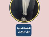 إعادة توصيل يد مبتورة بالكامل عند مفصل الرسخ الأيمن لمريض بجامعة طنطا.. صور