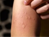 باحثون ينجحون فى تطوير لقاح يحمي من الحساسية 