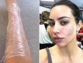 مرض جلدي مناعى تعانى منه كيم كاردشيان يجعلها تغلف جسمها بالبلاستيك