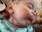 "جلد السمك" ينقذ طفلة حديثة الولادة من تسمم الدم