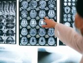 دراسة حديثة تكشف: دواء قديم للاضطرابات النفسية يساعد على الوقاية من الزهايمر