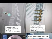 جراحات دقيقة تنقذ 3 مريضات من الشلل بمستشفى تمى الأمديد فى الدقهلية