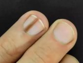 علامات تؤكد احتياجك لـ الكالسيوم