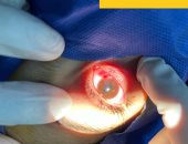 بقعة حمراء فى العين.. الأسباب والأعراض ونصائح للوقاية