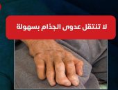 وزارة الصحة: عدوى الجذام لا تنتقل بسهولة واللمس لا يصيب بالعدوى