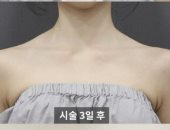 كوريات يخضعن لعمليات تجميل "حشوات" الكتف لتقليد نجمات موسيقى الكيبوب.. صور