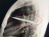 تنزانى يكتشف بالصدفة شفرة سكين دخلت جسمه منذ 8 سنوات بعد ألم فى الصدر