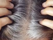 الشعر الأبيض فى العشرينات.. هل له أسباب مرضية