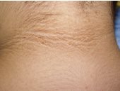 حلقة داكنة حول الرقبة.. علامة صامتة لا يجب تجاهلها وطرق العلاج والوقاية